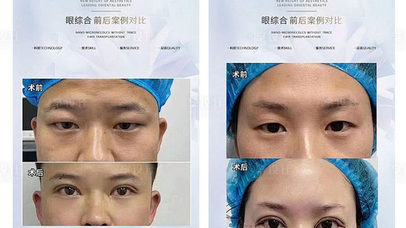抗衰激光与超声刀：揭秘两者的优缺点**