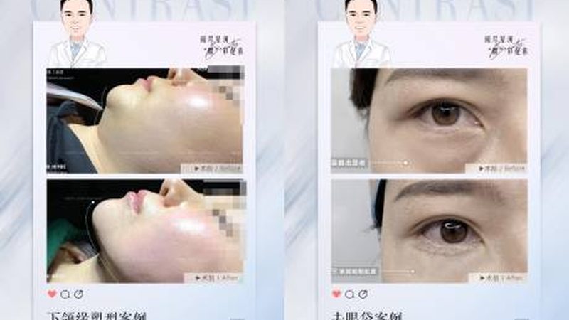 广州光子嫩肤团购注意事项
