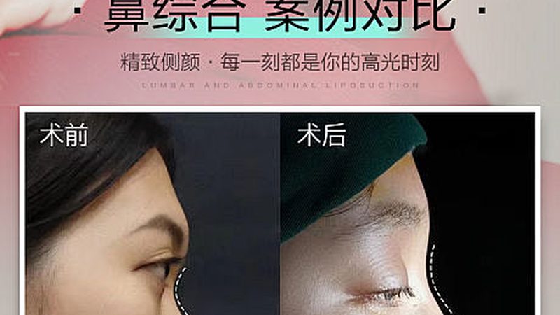 面部提升，埋线还是线雕？性价比揭秘