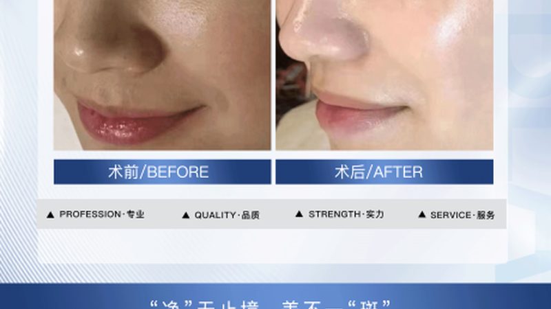 肉毒素与玻尿酸：性价比之争，揭秘真实差异