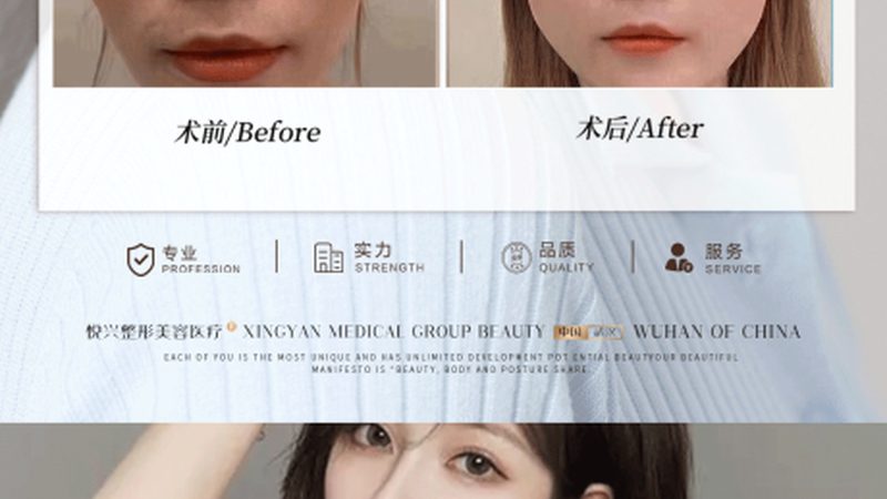 双眼皮贴的隐患：揭秘松弛与自然双眼皮的真相