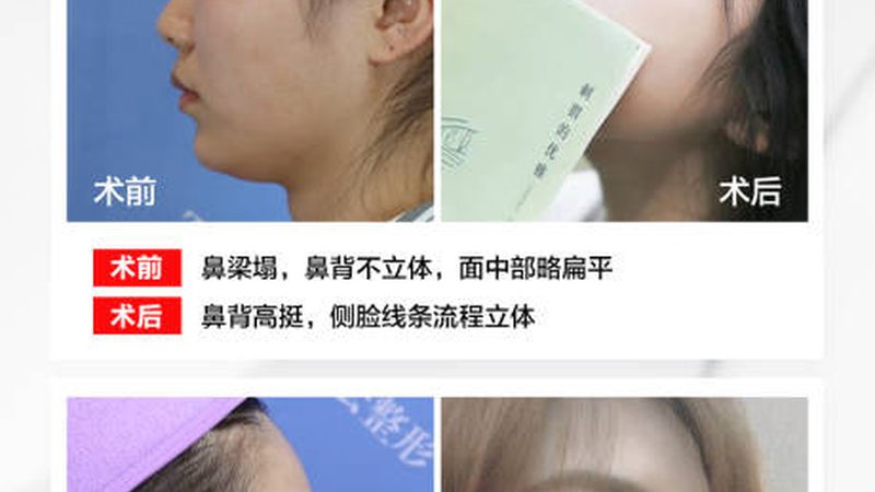 激光祛斑与皮秒激光：雀斑治疗的两种选择