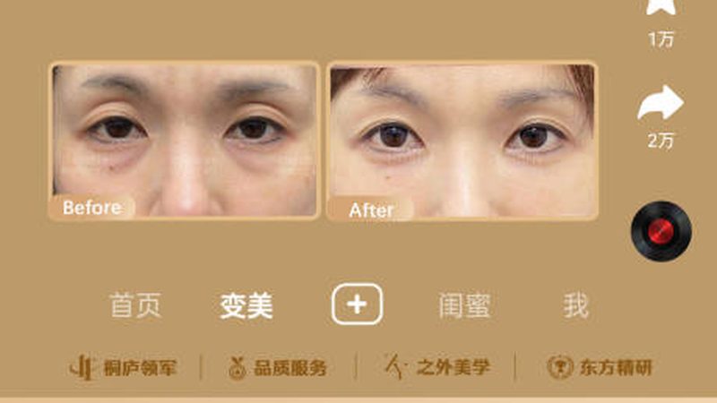 光子嫩肤后洗脸的最佳时机揭秘